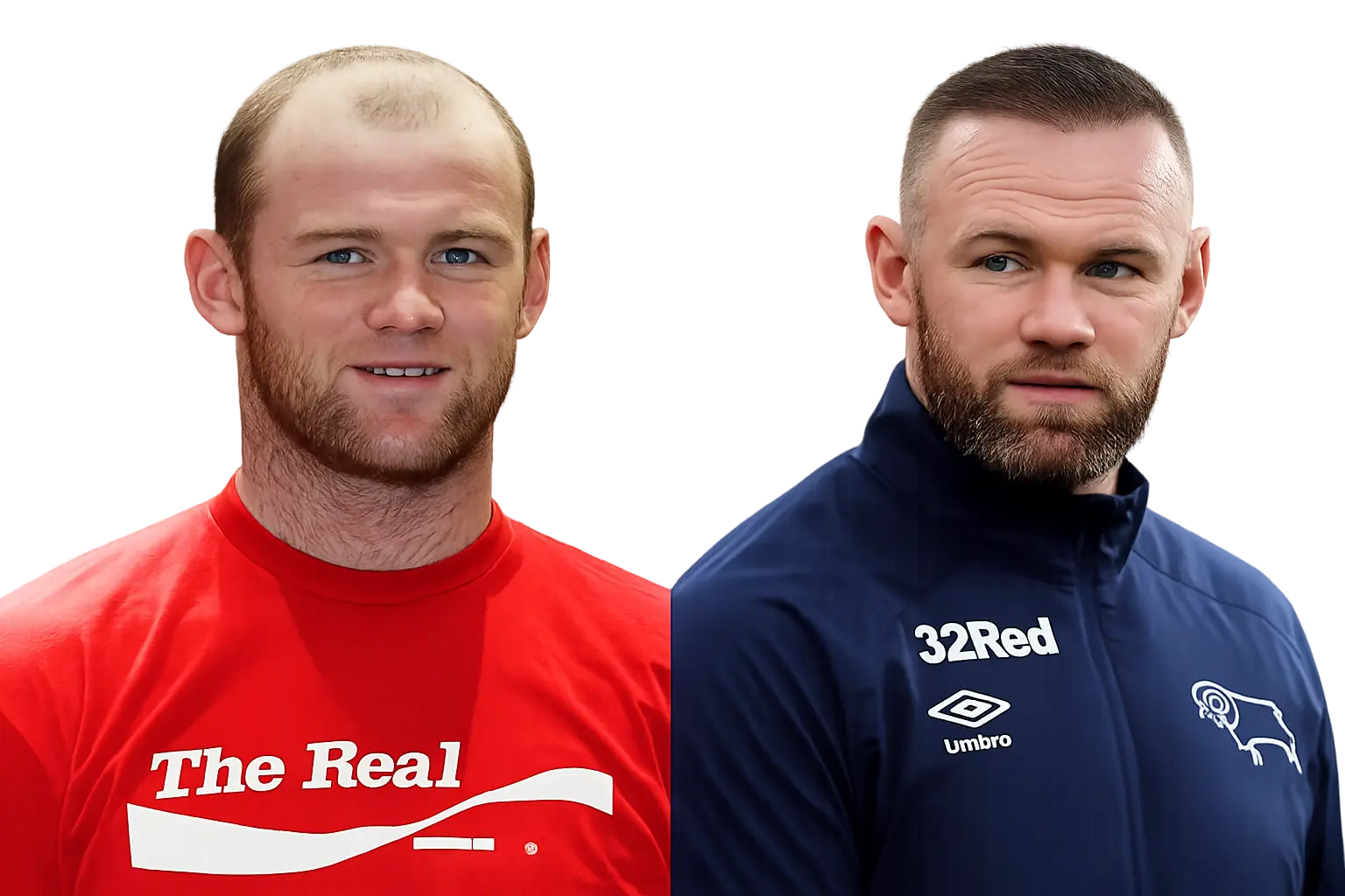 Wayne Rooney Hair Transplant Cost Procedure Results Wayne Rooney Hair Transplant Cost Procedure Results
