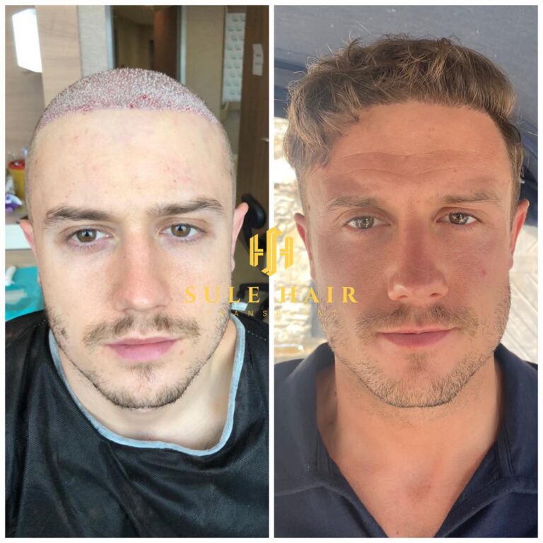 Haartransplantation in der Türkei vor und nach dem Ergebnis 15.03.2023