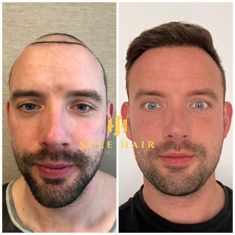 Haartransplantation in der Türkei vor und nach dem Ergebnis 18.03.2023