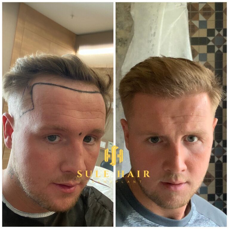 Haartransplantation Truthahn vor und nach dem Ergebnis 19.03.2023
