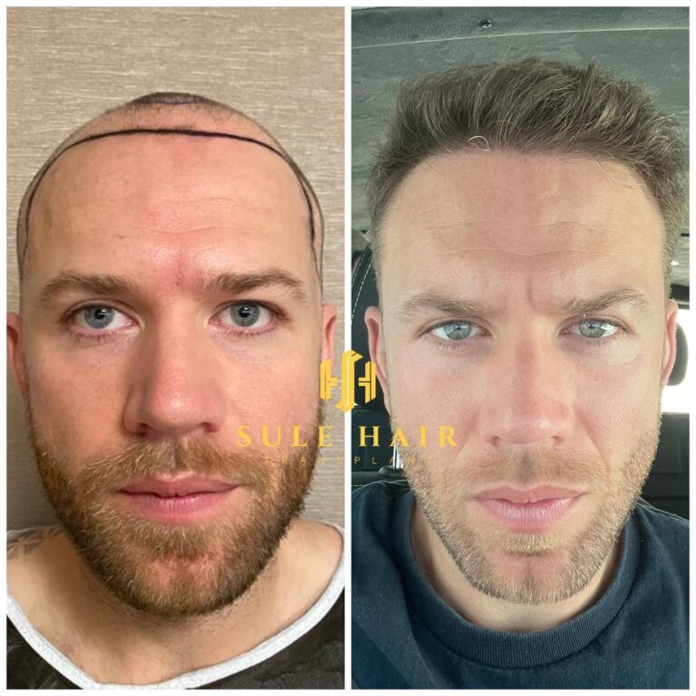 Haartransplantation in der Türkei vor und nach dem Ergebnis 20.03.2023