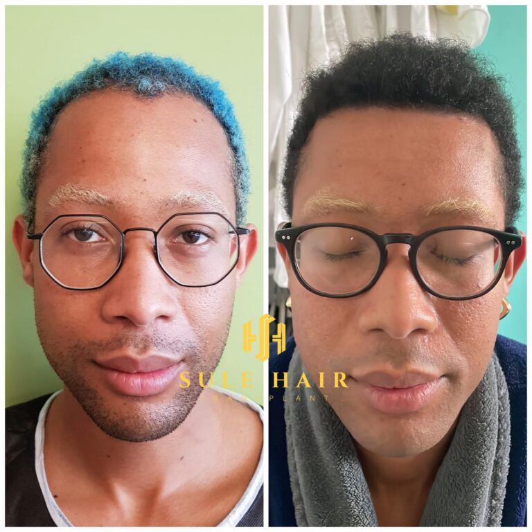 Haartransplantation in der Türkei vor und nach dem Ergebnis 20.03.2023