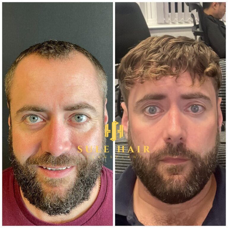 Haartransplantation in der Türkei vor und nach dem Ergebnis 17.01.2023