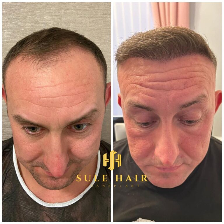 Haartransplantation in der Türkei vor und nach dem Ergebnis 15.01.2023