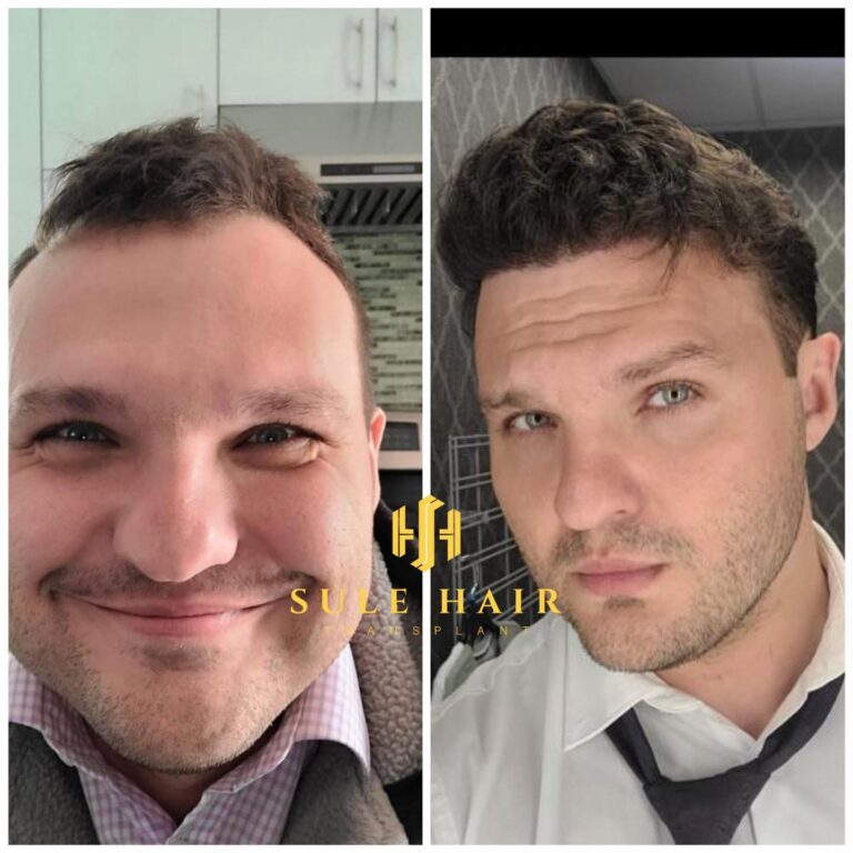 Haartransplantation in der Türkei Haartransplantation in der Türkei vor und nach dem Ergebnis 18.02.2023