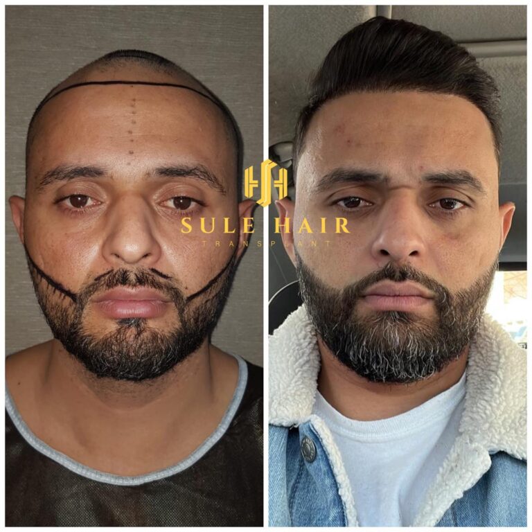 Haartransplantation in der Türkei vor und nach dem Ergebnis 16.02.2023