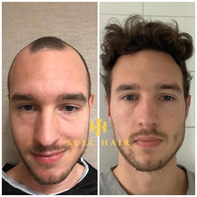Haartransplantation in der Türkei vor und nach dem Ergebnis 15.02.2023