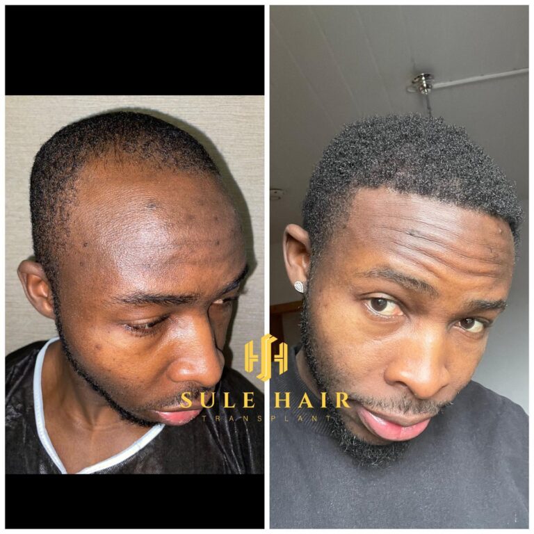 Haartransplantation in der Türkei vor und nach dem Ergebnis 18.01.2023