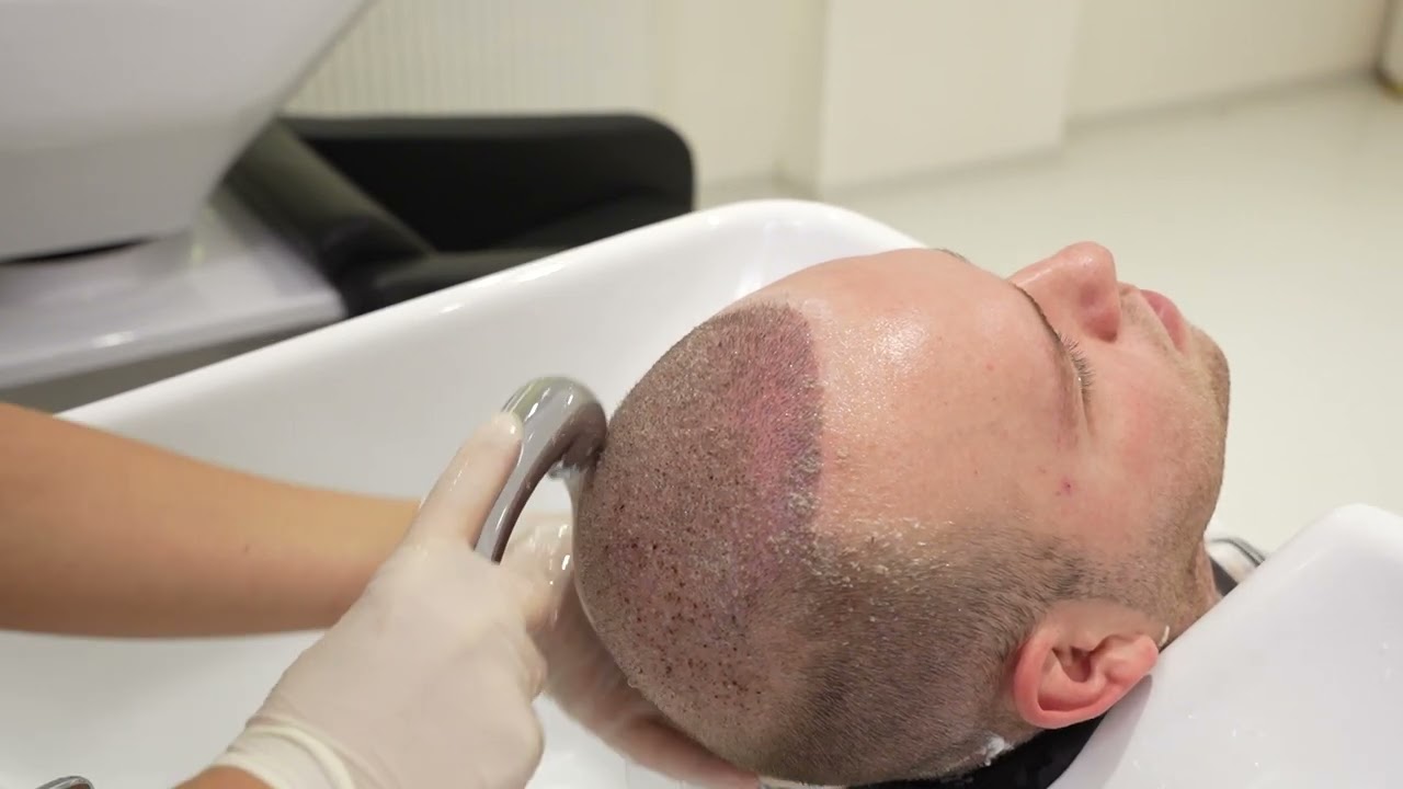 watch and learn how to remove scabs after a hair transpant in sule hair clinic