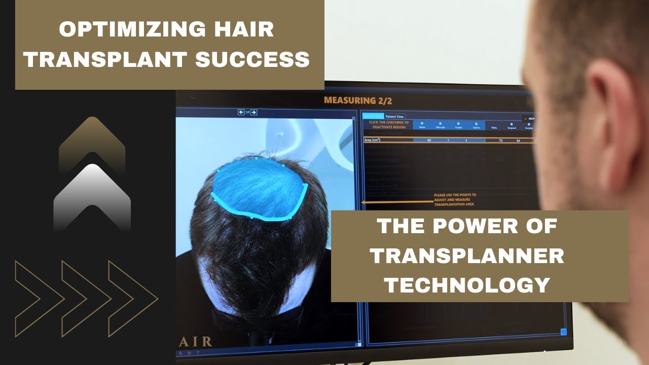 optimizing hair transplant success