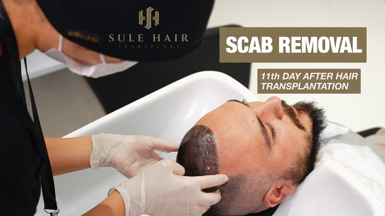 scab and crust removal after hair transplant