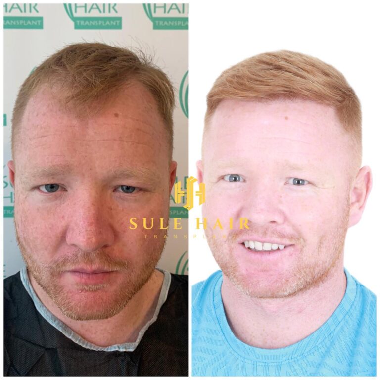 Haartransplantation in der Türkei vor und nach 24.03.2023