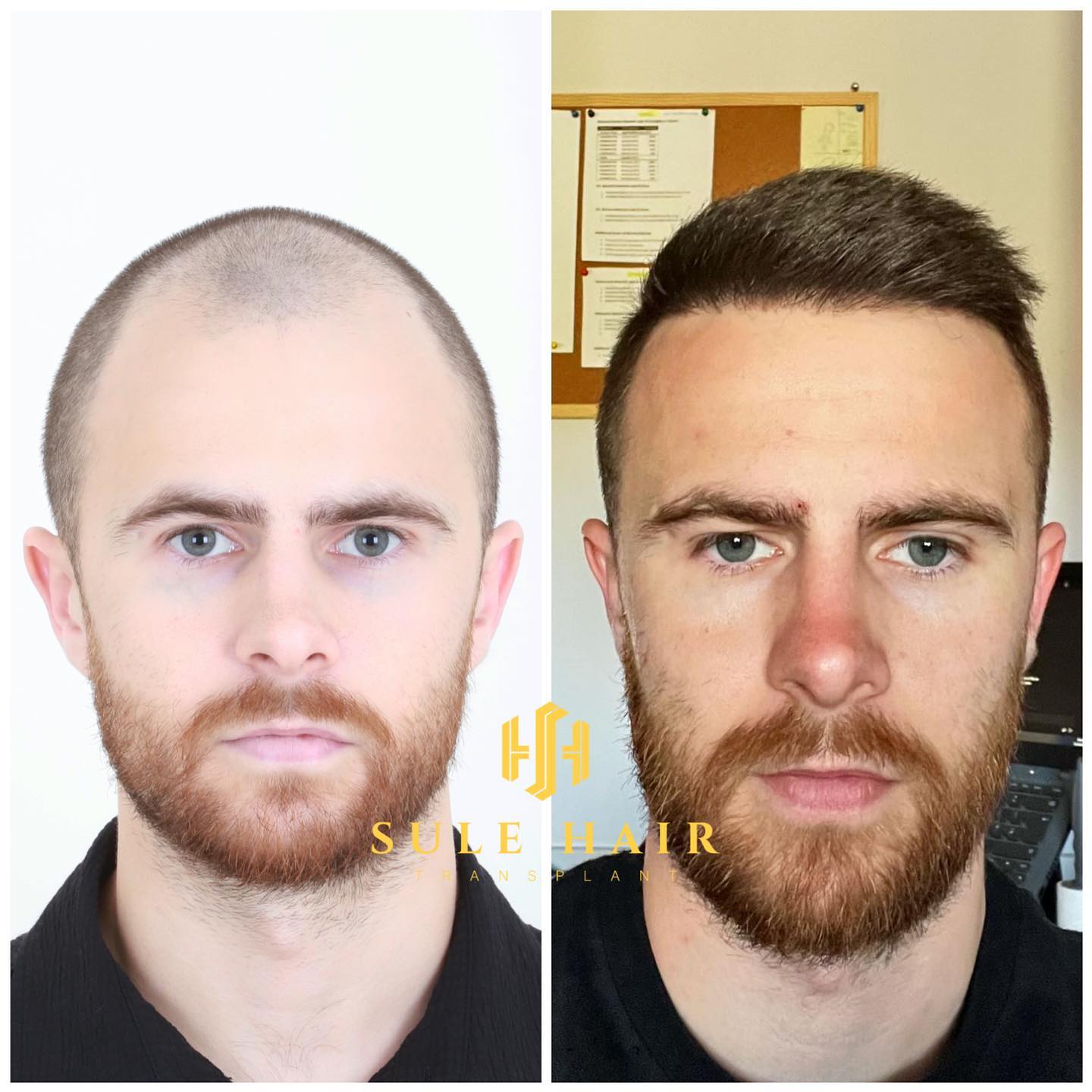 hair-transplant-turkey-before-and-after-sule-hair-result-29.04.2023.jpg.jpg