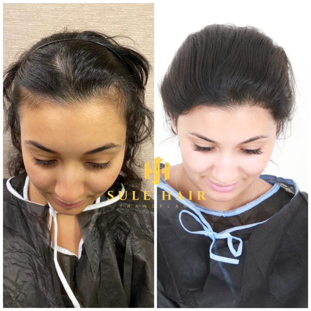woman hair transplant result after one year