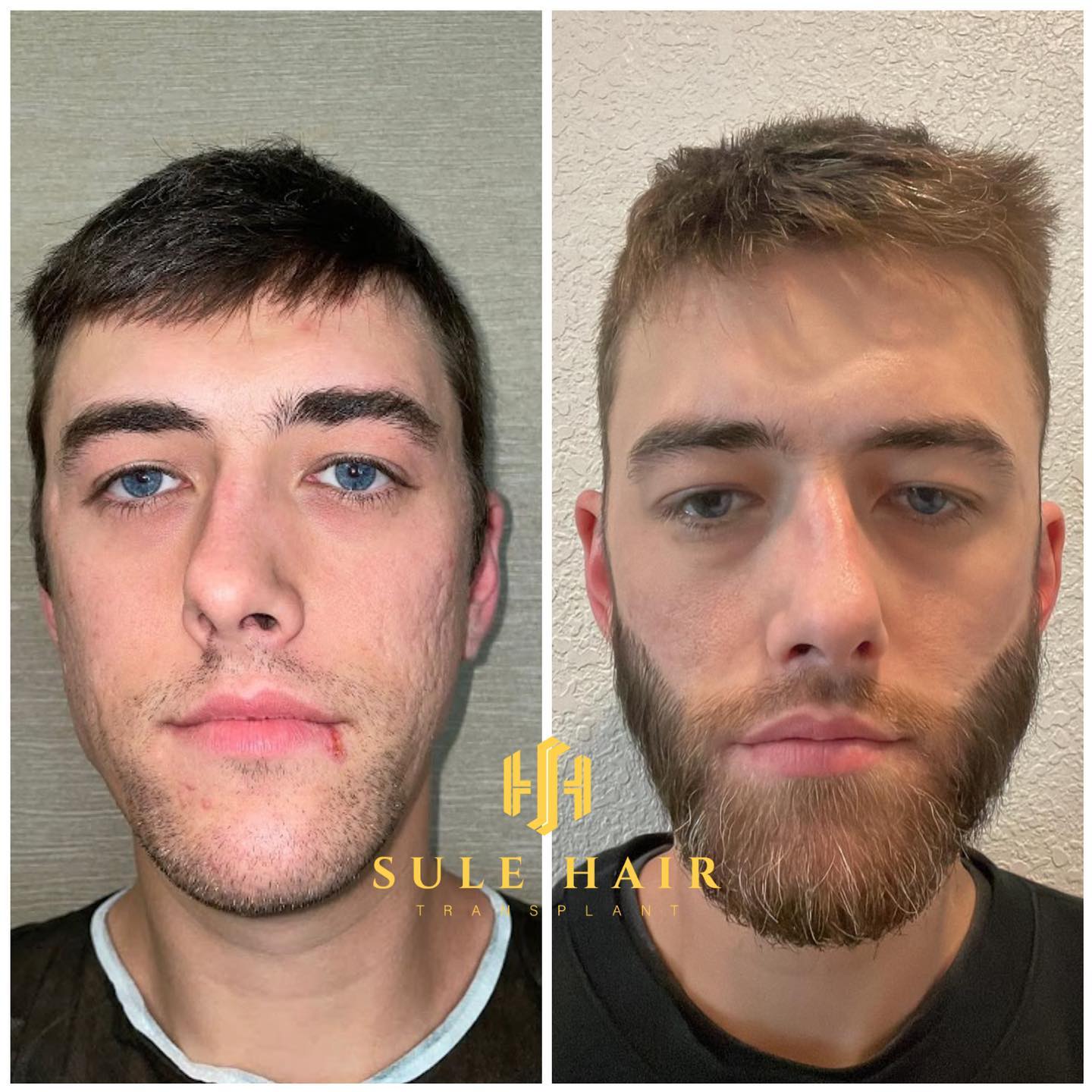 beard transplant before and after
