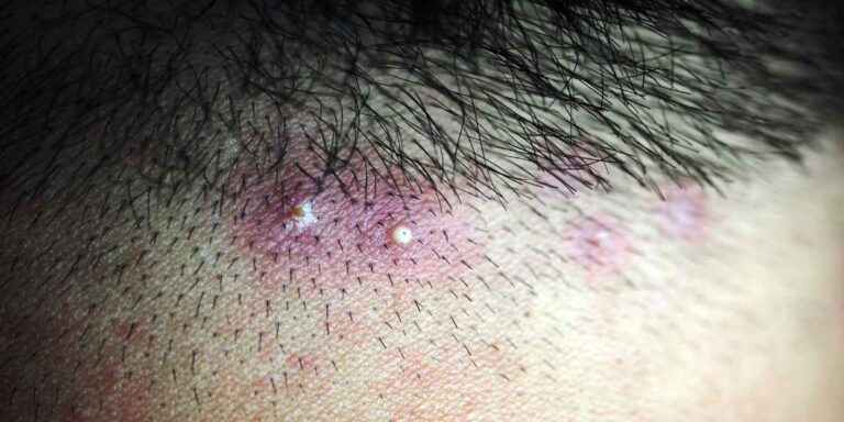 Scalp Pimples after hair transplant