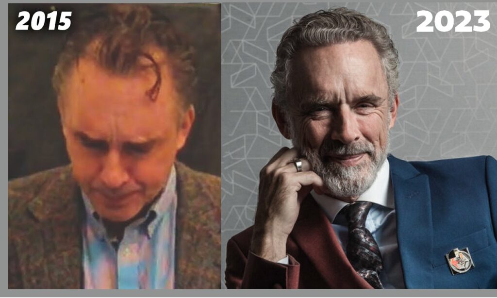 Jordon Peterson Hair Before After