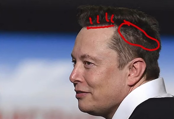 Elon Musk Hair Transplant hairline