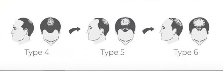 types of balding