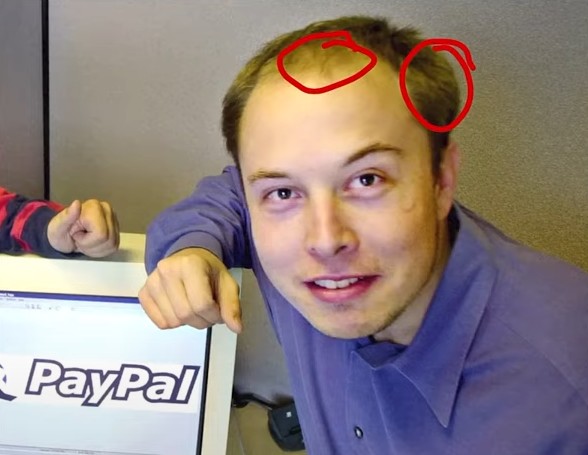 Elon Musk's Hair Loss at 32 years old.