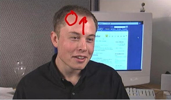 Elon Musk's Hair loss 