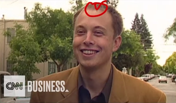 Elon Musk Hair loss in a CNN business interview