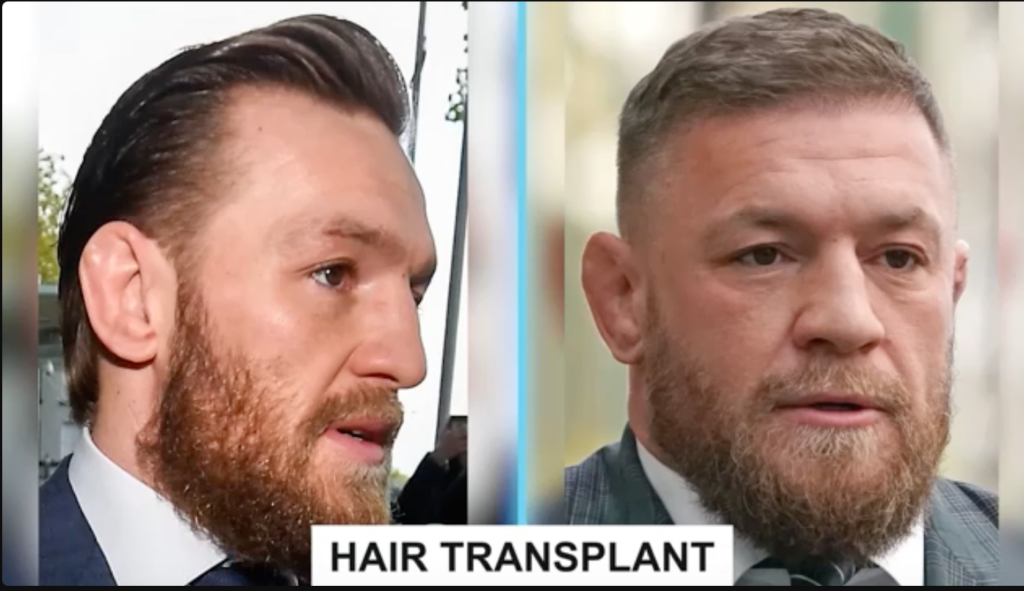 Conor Mcgregor Hair Transplant