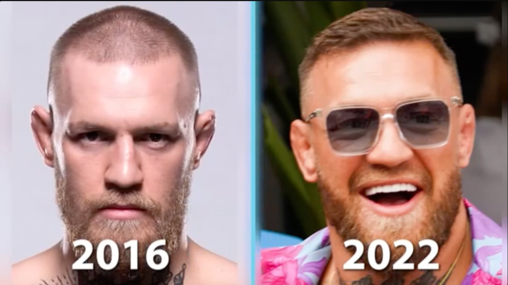 Conor Mcgregor Hair Transplant before after