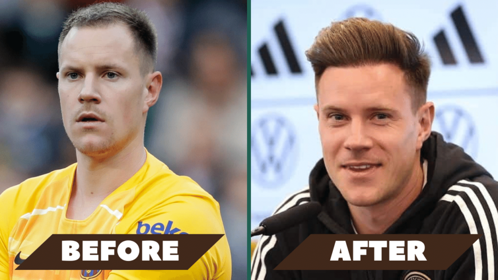 Ter Stegen's hair transplant before and after