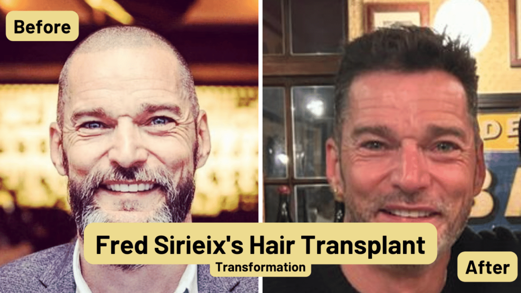 Fred Sirieix's Hair Transplant