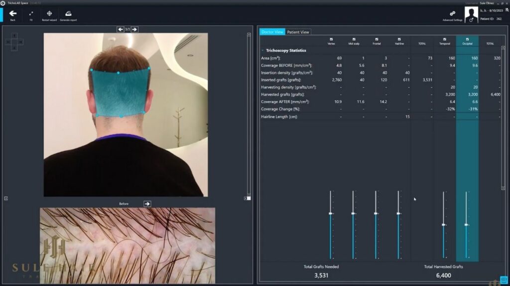 graft calculate with software hair transplant in Turkey sule clinic