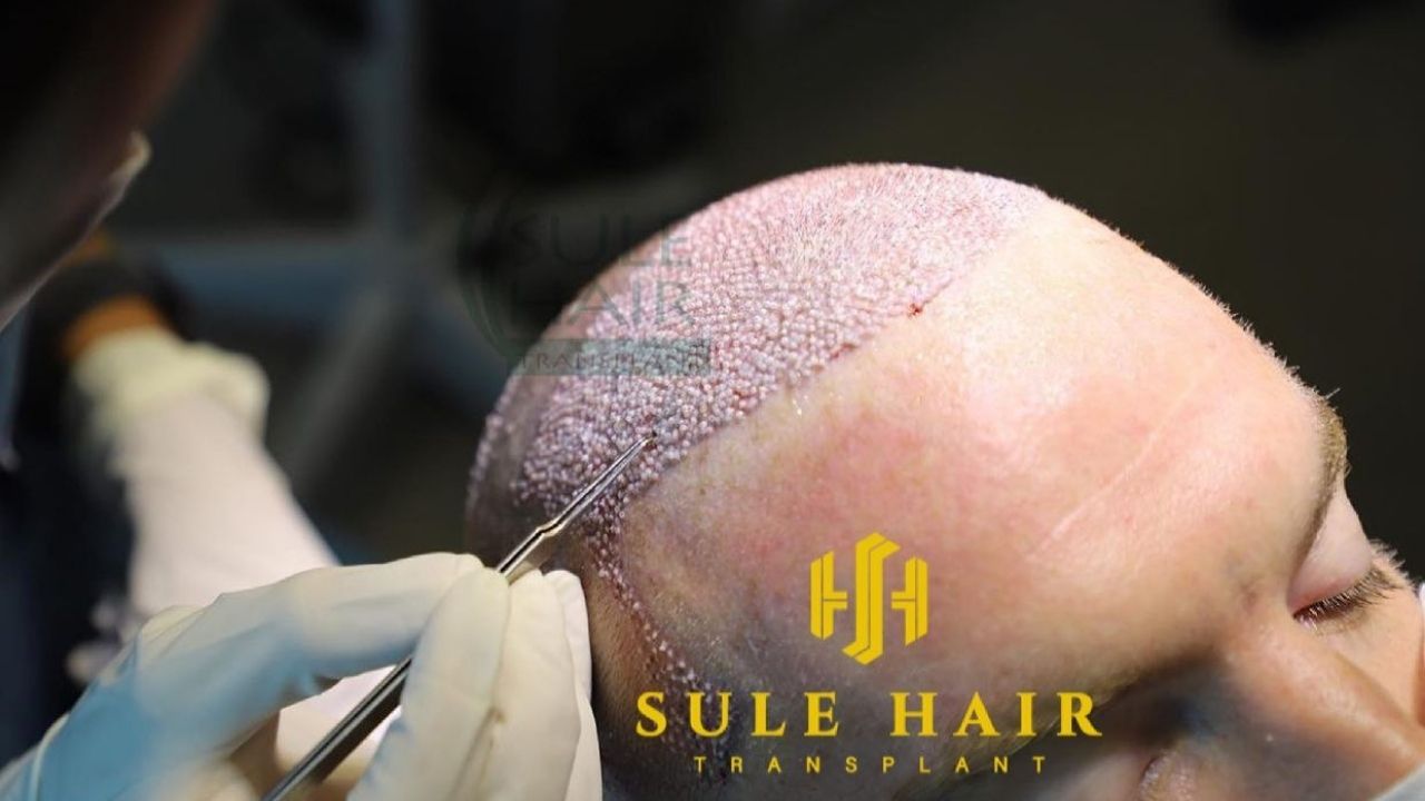 Can a diabetic patient do a hair transplant?
