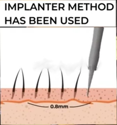 implanter method hair transplant