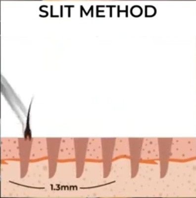Slit method hair transplant