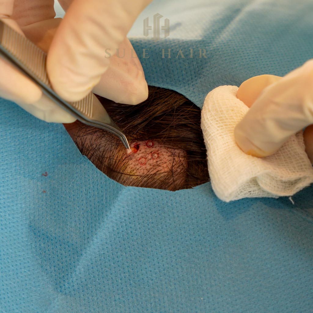Tissue Collection during the stem cell treatment hair transplant