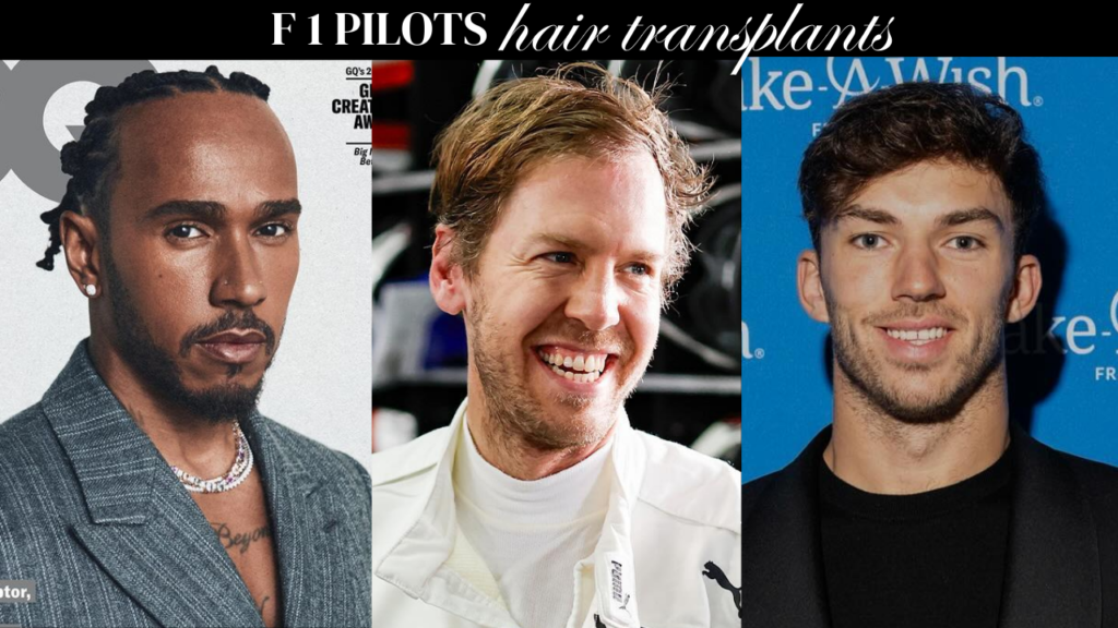 F1 Pilots Hair Transplants