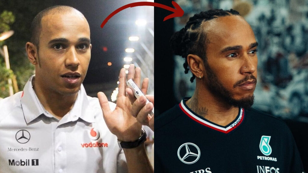 Lewis Hamilton Hair Transplant