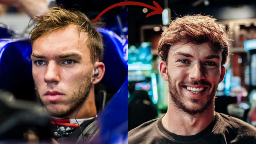 Pierre Gasly Hairline before after