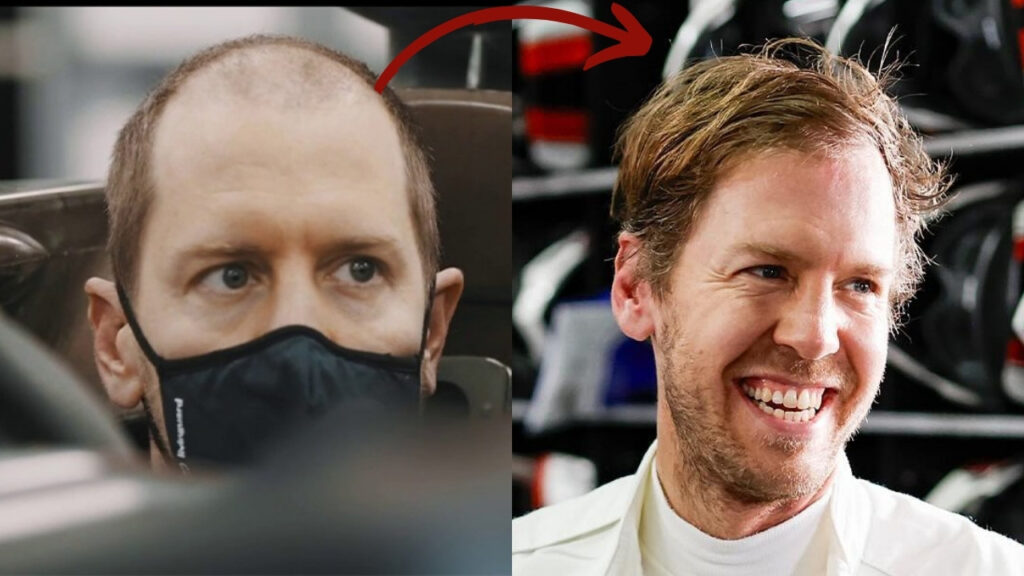 Sebastian Vettel Hair Transplant