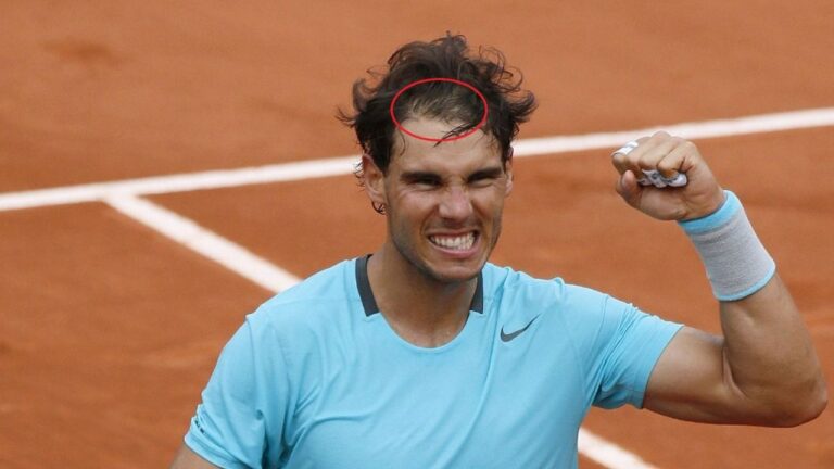 Greffes de cheveux chez les joueurs de tennis