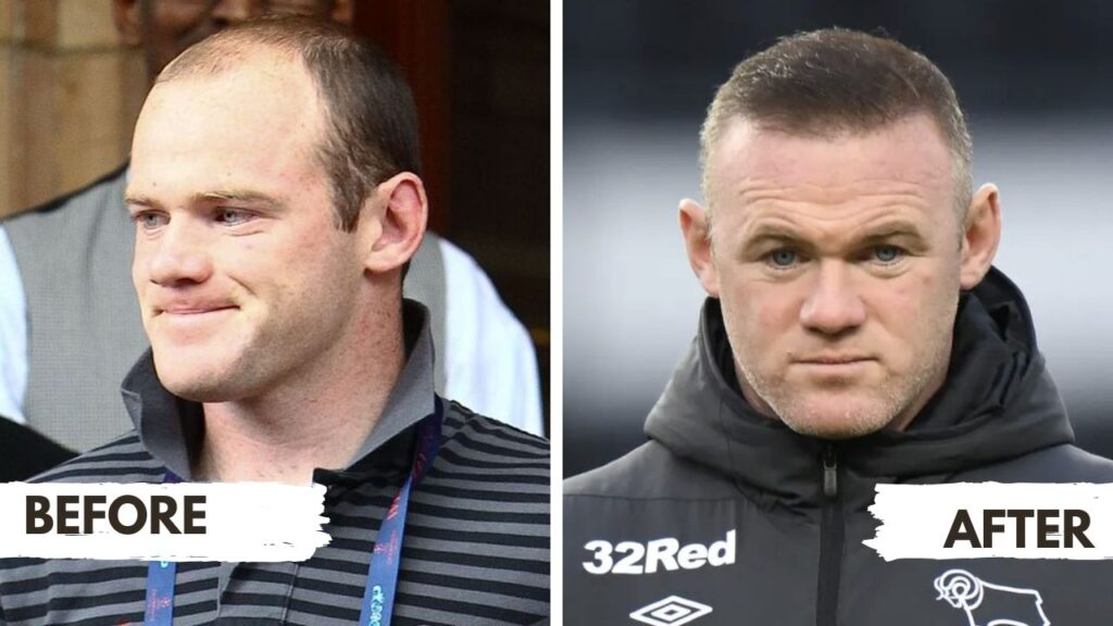 Wayne Rooney hair transplant before after