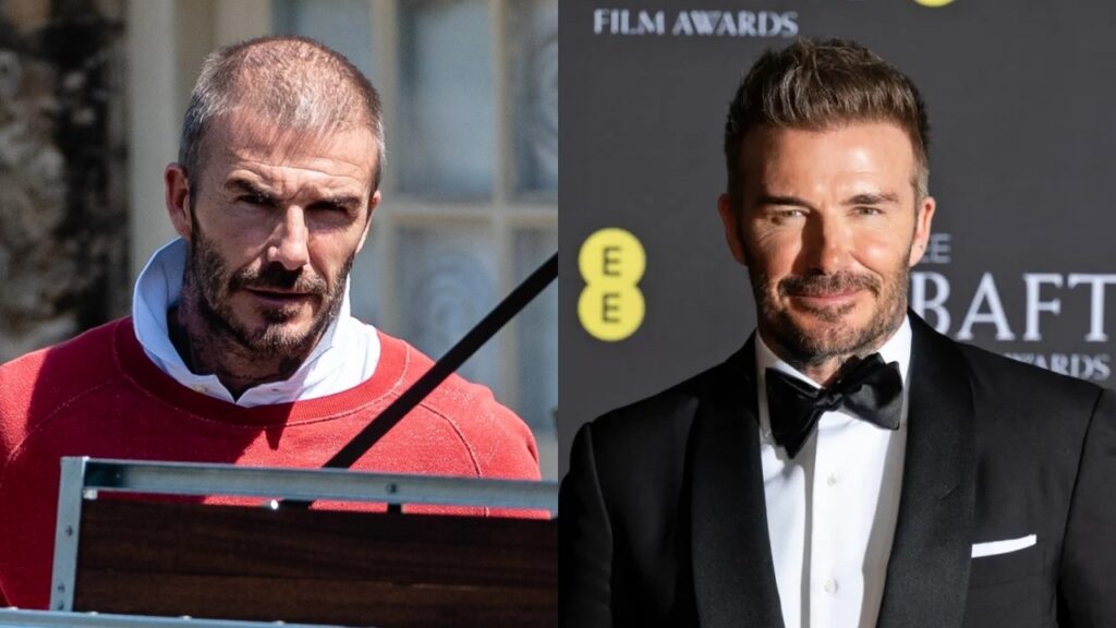 Beckham's Hair Transplant
