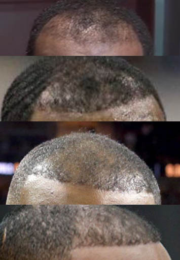 lebron james hairlines