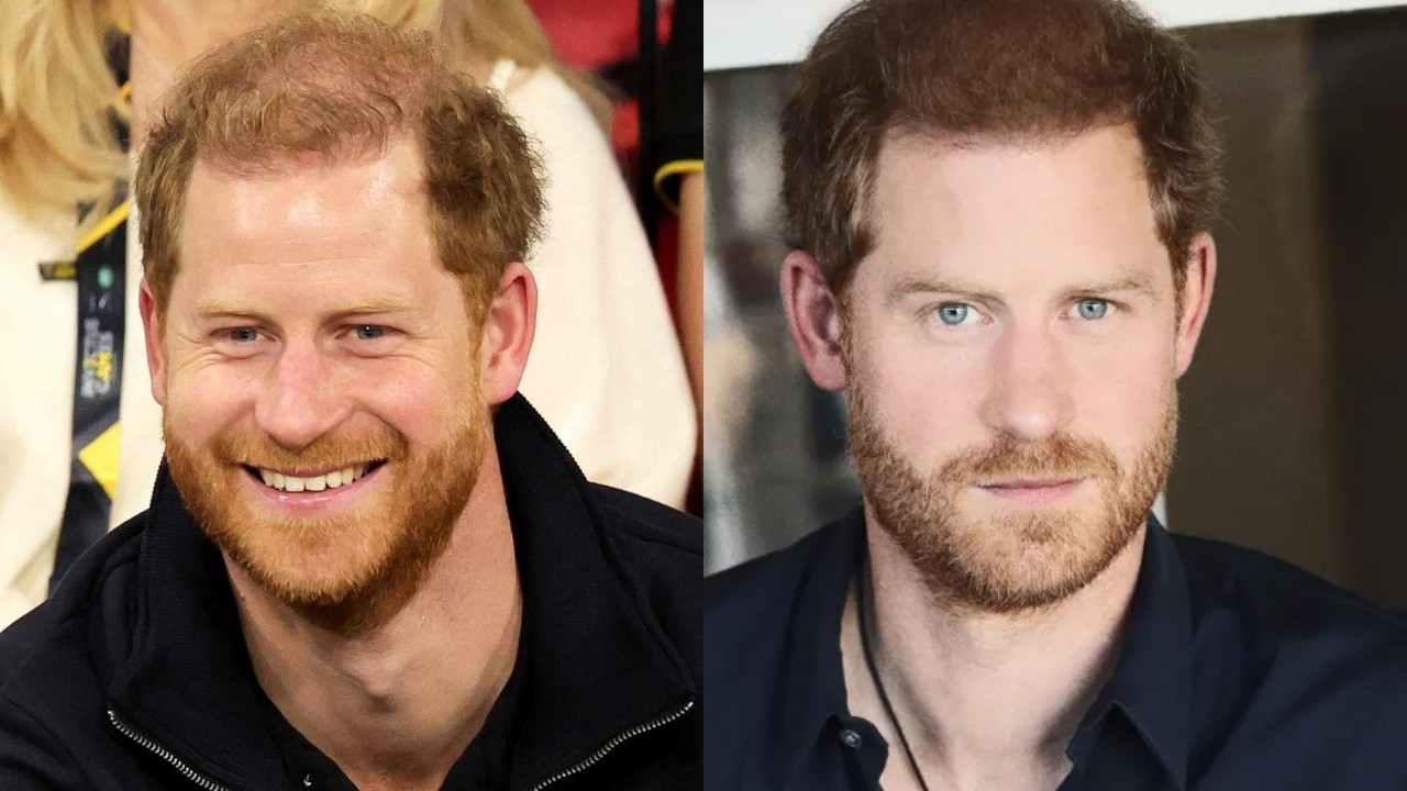 prince harry hairline