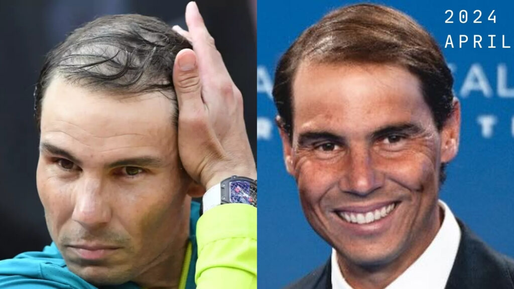 Rafael Nadal Hair Transplant