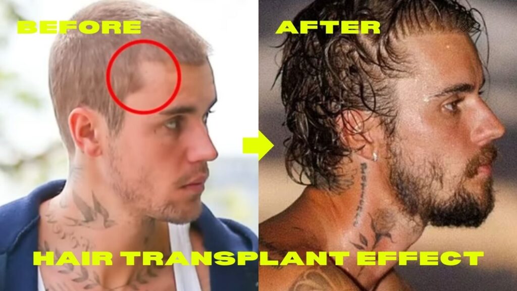 Justin Bieber hair transplant before after