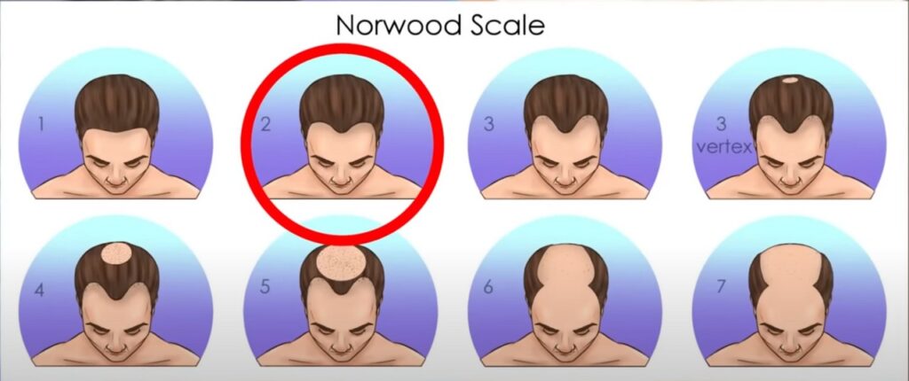 Justin Bieber's norwood scale