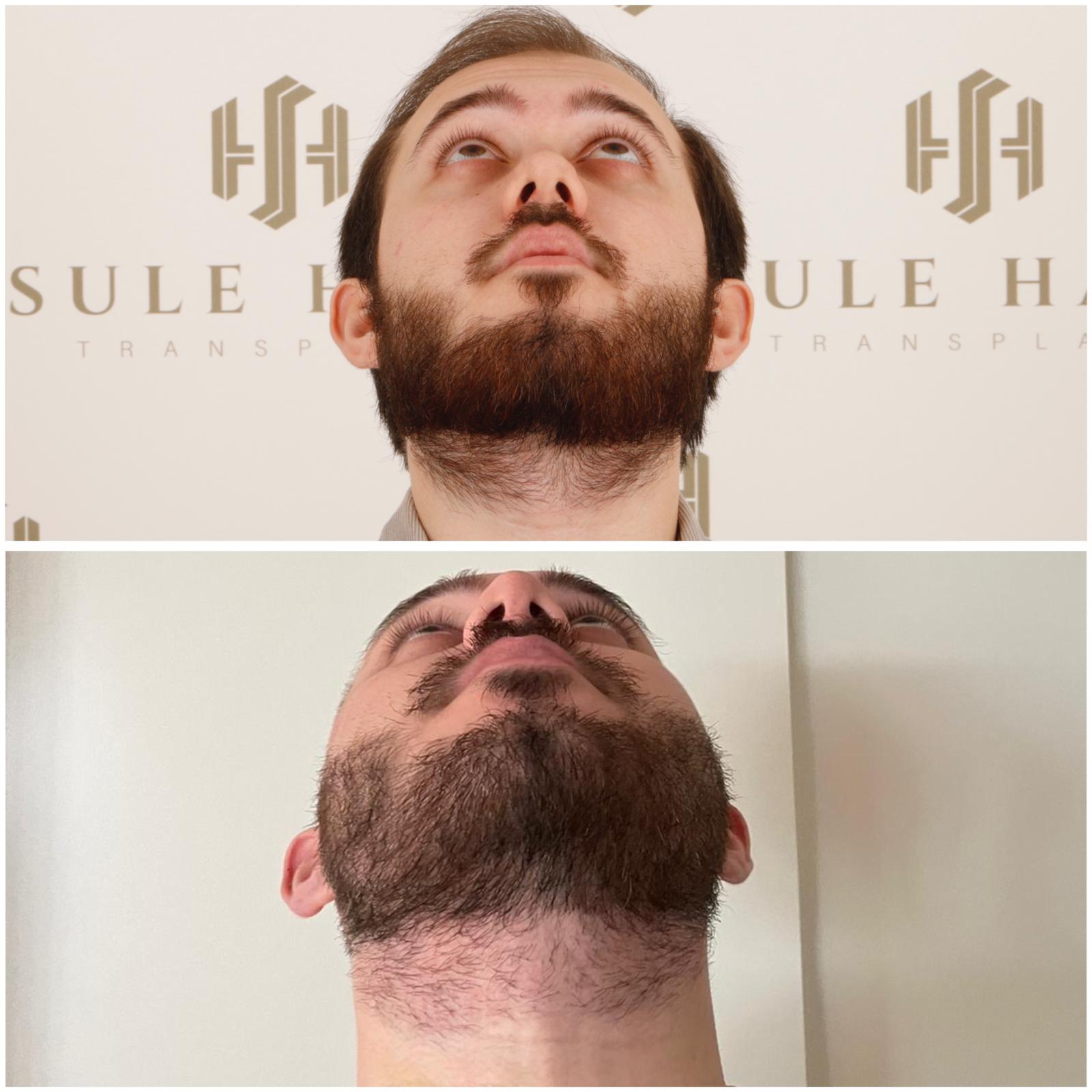 Área doadora da barba após 10 dias