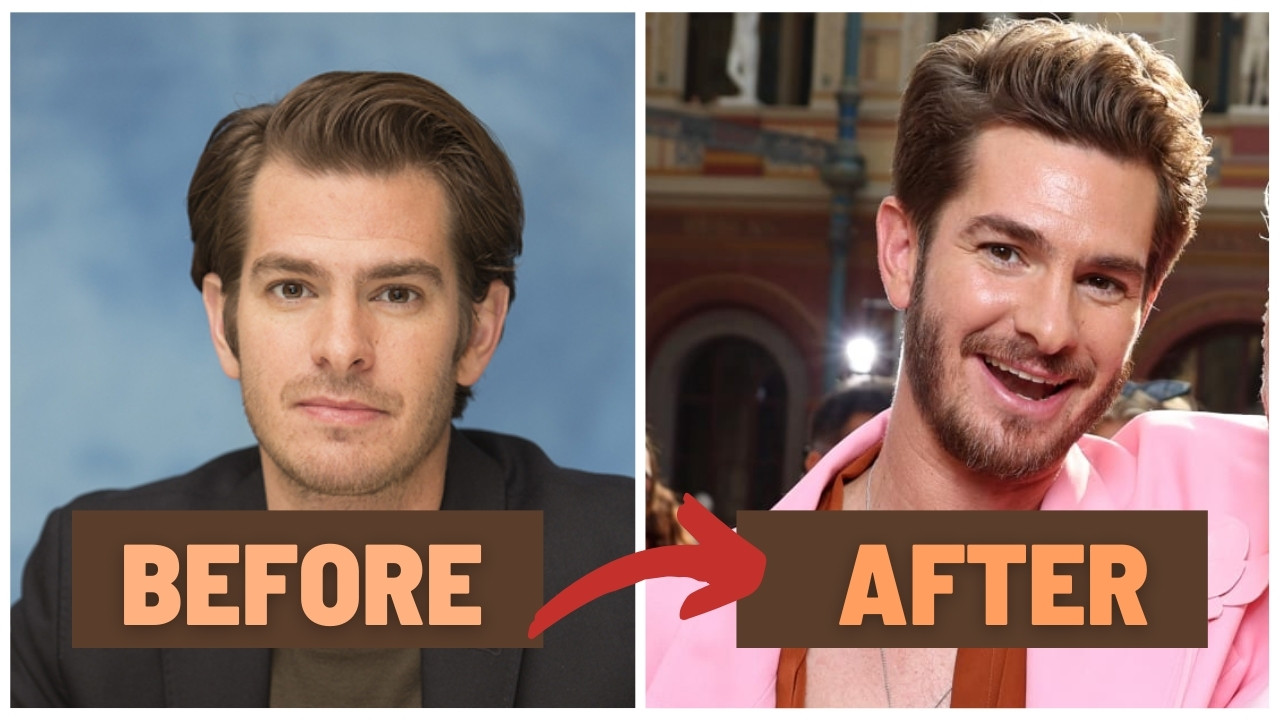 Andrew Garfield Hair Transplant: Expert Analysis & Details - SULE HAIR ...