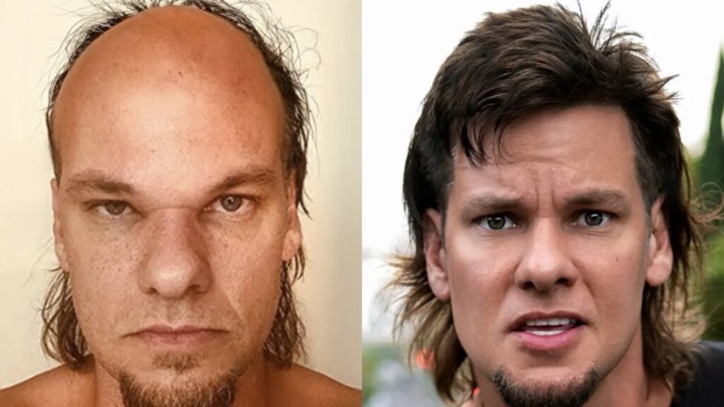 Theo Von’s Hair Transplant